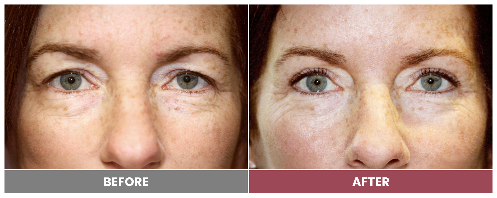 Upper Blepharoplasty - Case 25